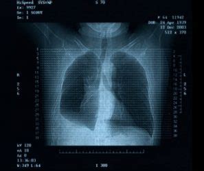 Akciğer mr neden çekilir